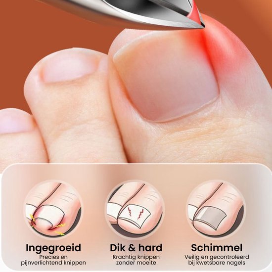 Teennagel wordt met een kniptool nauwkeurig en pijnvrij geknipt bij rood en geïrriteerd gebied.