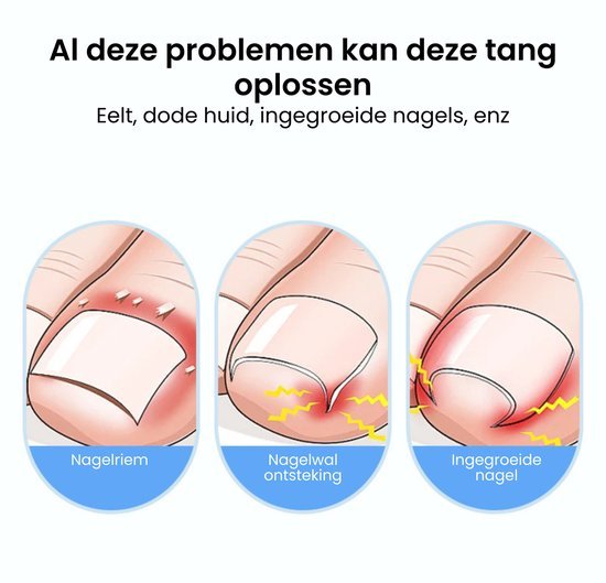 Illustratie van nagelproblemen met eelt, ontsteking en ingegroeide nagel uitleggen in drie stappen