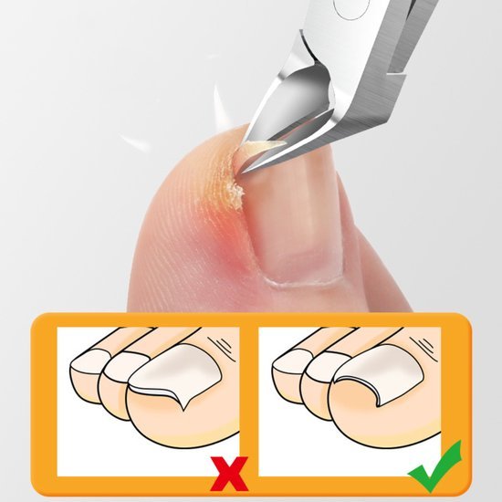 Close-up van een teennagel waarbij een nagelriemknipper ingegroeide nagel verzorgt, correct knippen geïllustreerd.