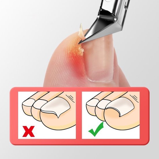 Teennagelcorrectie met kniptang bij een ontstoken en ingegroeide nagelrand.