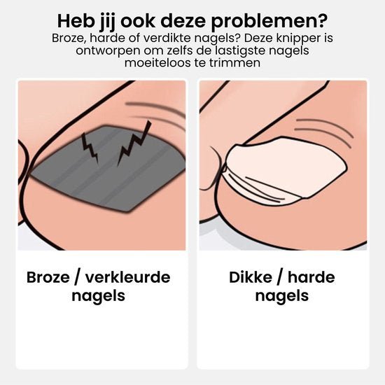 Illustratie van broze verkleurde nagels en dikke harde nagels problemen bij nagelverzorging