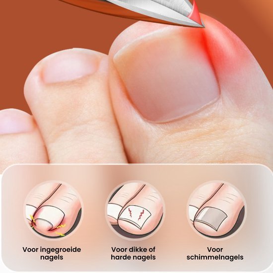 Close-up van een teen met ingegroeide nagel en illustraties van nagelproblemen en behandelingstips.