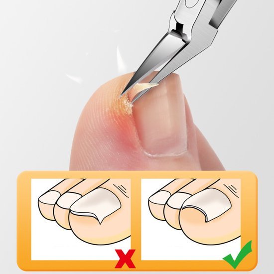 Close-up van een teennagel met een pincet dat een ingegroeide nagel verwijdert, met instructies.