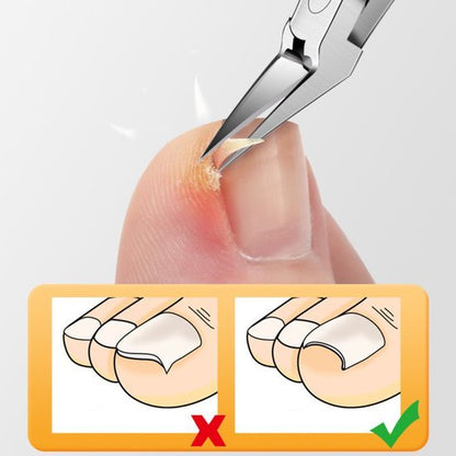 Close-up van een teennagel met een pincet dat een ingegroeide nagel verwijdert, met instructies.
